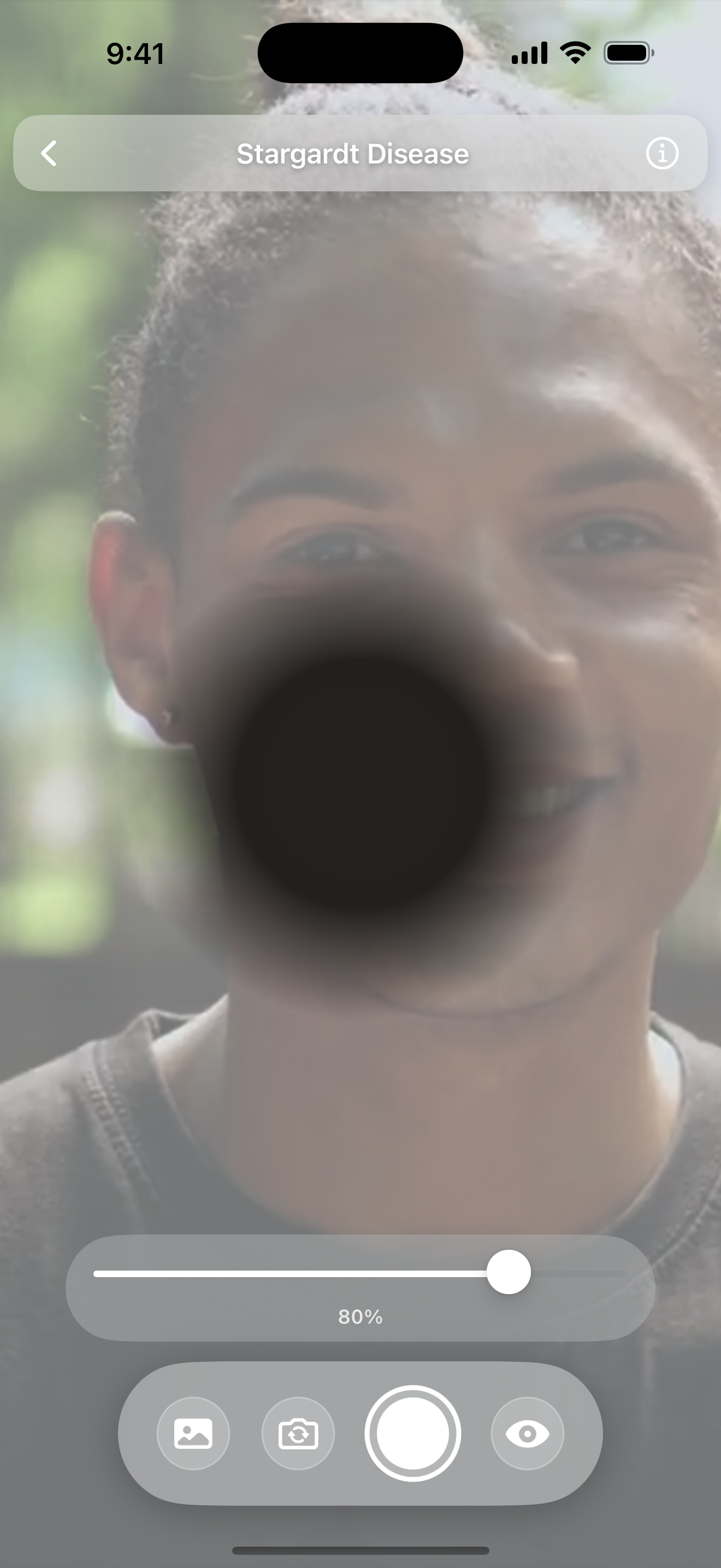 Screenshot showing Stargardt Disease simulation - central vision loss effect